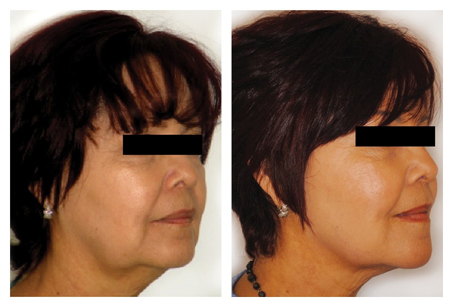Wrinkle reduction and face and neck firming
