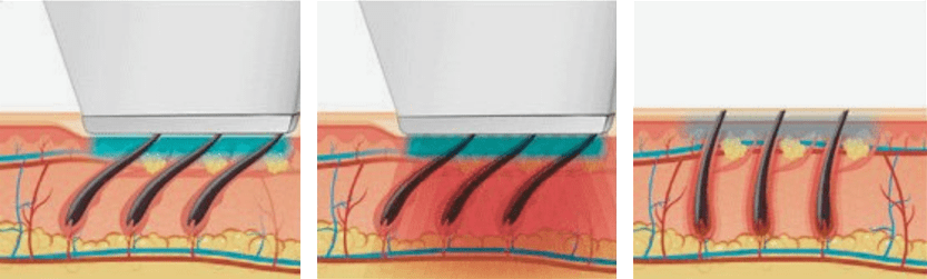 Épilation au laser
