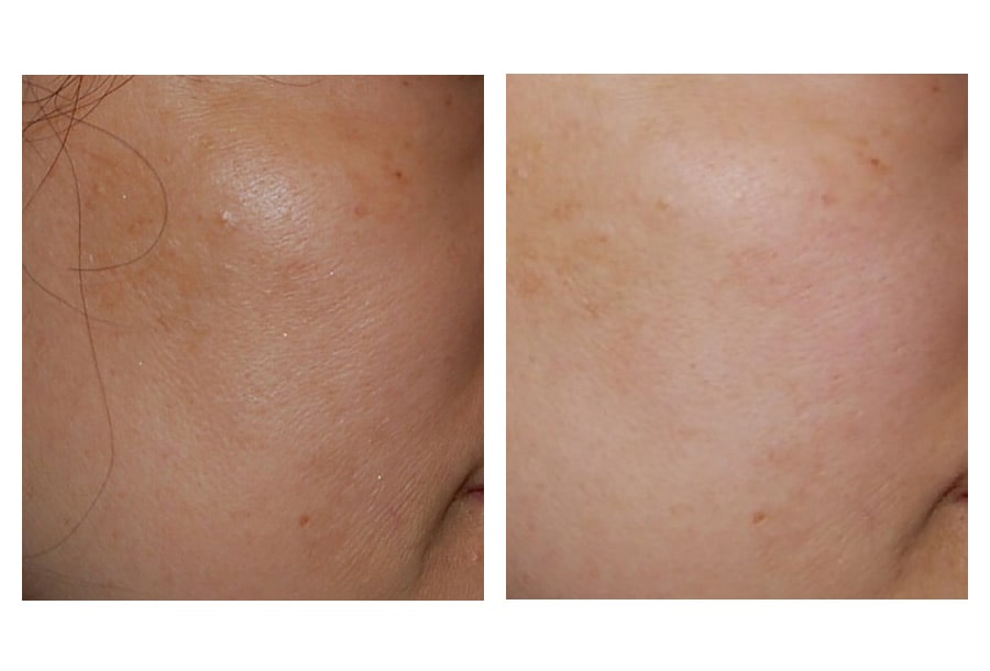 Tonification de la peau
